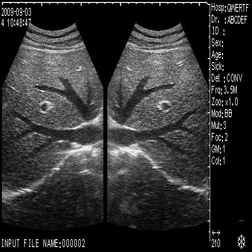 CE Portable Ultrasound Scanner Machine with 2 Probes  